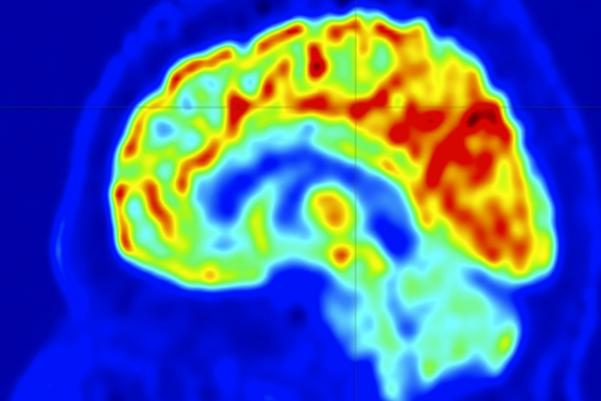 og_newsvirginiaedu_content_uva-develops-imaging-approach-help-stop-epilepsy-seizuresutm_sourceDailyReport_utm_mediumem.jpg